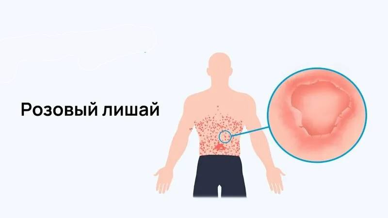 Вспышка розового лишая в Таиланде