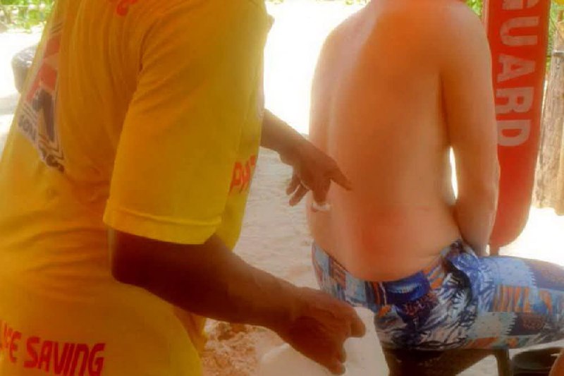 Ожоги от медуз на пляже Патонг