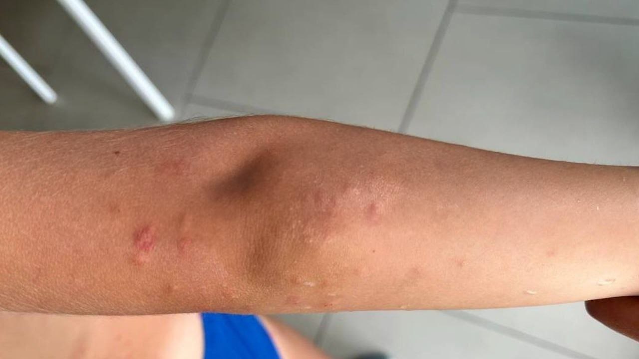 Укусы планктона на пляжах Таиланда