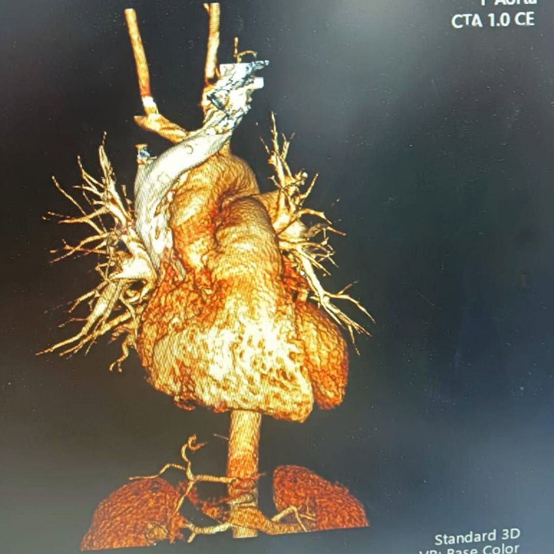 Россиянин тяжело травмирован в ДТП в Таиланде