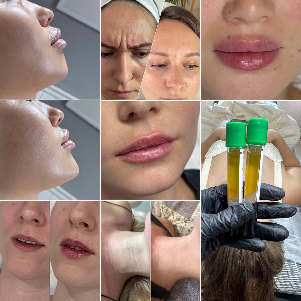 Услуги врача-косметолога Виктории